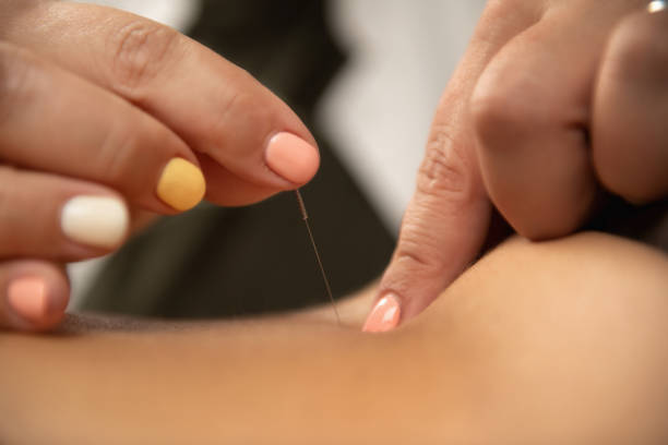 Acupuncture for Ischialgia Back Pain